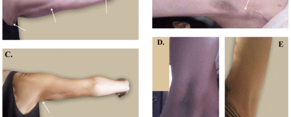 Dynamic Angular Petrissage as Treatment for Axillary Web Syndrome Occurring after Surgery for Breast Cancer: a Case Report Paul A. Lewis, BA, RMT, CDT, Joan E. Cunningham, PhD