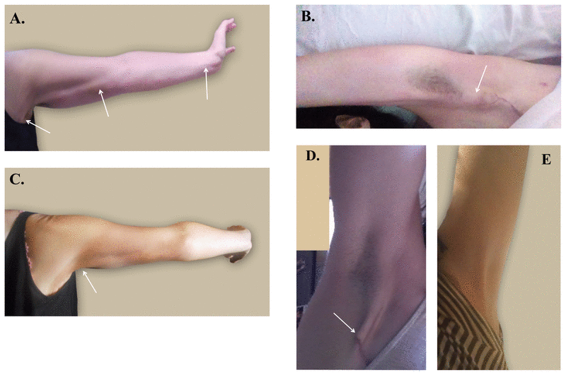 axillary-web-syndrome